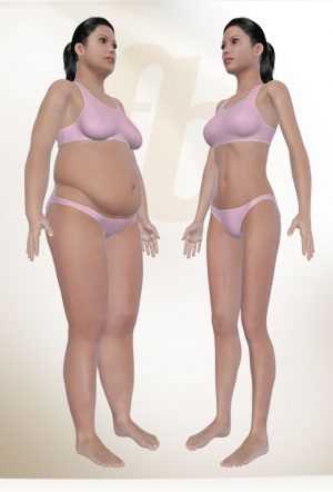 Liposuction resmi