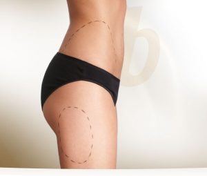 Liposuction