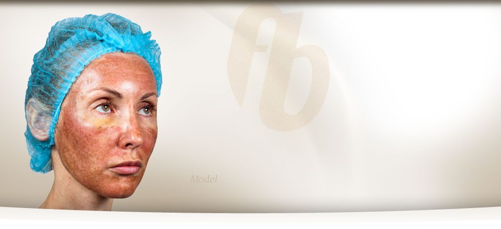 yanik-ameliyat-yara-izi